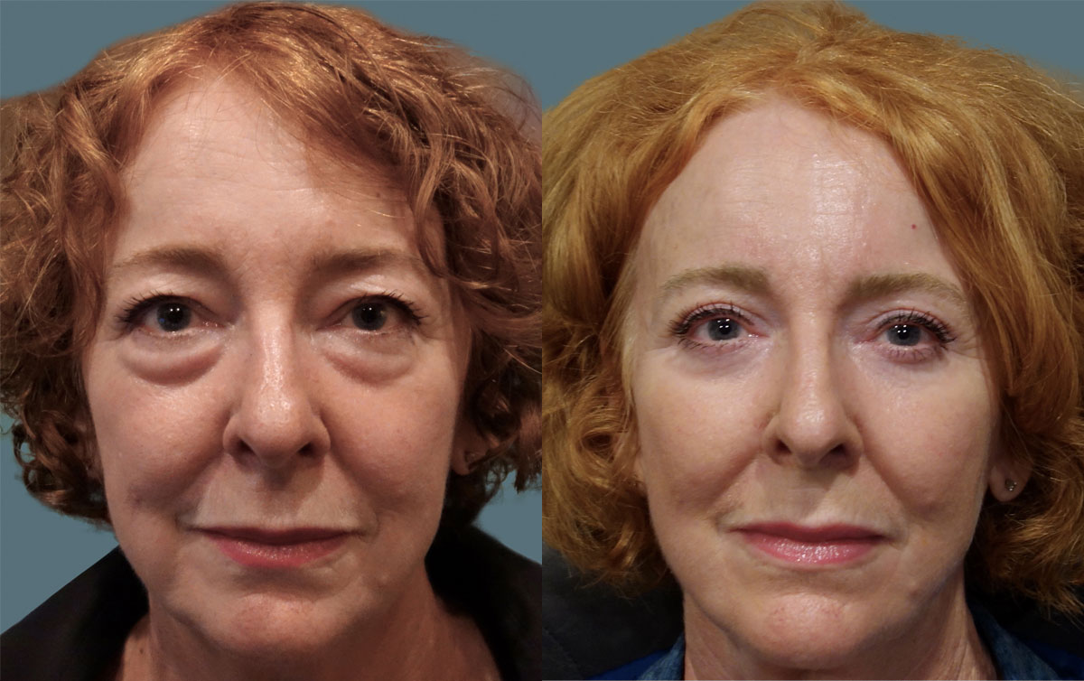 Get Insurance to Pay for Eyelid Surgery